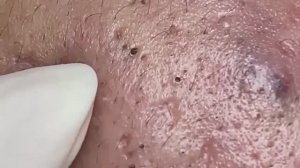 Удаление акне у косметолога: тонкая работа #887593