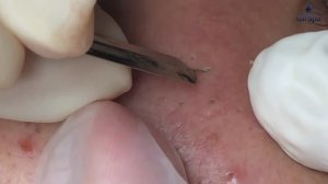 Сеанс профессиональной чистки лица от черных точек