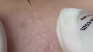 Удаление глубоких комедонов- SDS#179