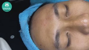 Asmr. Выдавливание прыщей и белых точек HANA #55