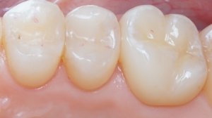 ВЕРТИКАЛЬНОЕ ПРЕПАРИРОВАНИЕ | РЕТРАКЦИЯ | ПОЗИЦИОНЕР | КОРОНКА ДЦ