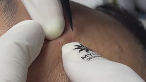 Asmr. Лечение белых точек. Linh #14