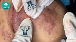 Механическая чистка от закрытых комедонов: основной метод удаления. HANA #54