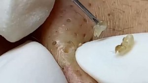 Профессиональная чистка лица от милиумов и закрытых комедонов #887581