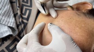 Профессиональное удаление закрытых комедонов: экстракция Linh #13