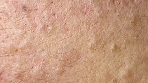 Лучшее выдавливание прыщей. Часть 1 - SDS#181