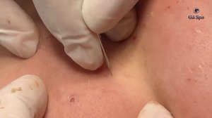 Чистка лица: черные точки и закрытые комедоны — 38 минут — Терапия угревой сыпи