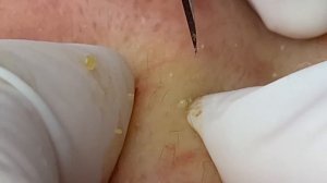 Чистим лицо от закрытых комедонов - ТТ#68