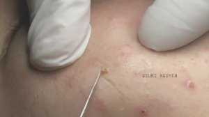Удаление воспаленных прыщей Suri 13