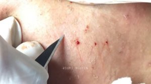 Чистка мужского лица: достаем все скрытые прыщи Suri 33