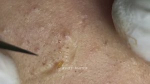 Настоящий праздник акне и комедонов Suri 30