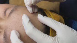 Специалист аккуратно удаляет (выдавливает) белые точки - ТТ#69