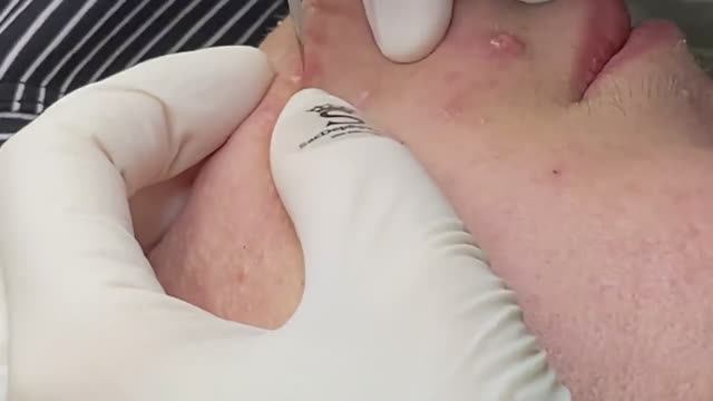 Акне на подбородке и скулах - SDS#187