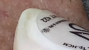 Asmr. Убирание угрей с кожи лица 𝐖𝐢𝐧 #𝟏𝟐𝟒𝟖