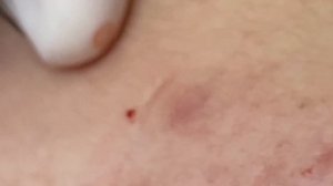 Чистим кожу от закрытых комедонов и черных точек - ТТ#64