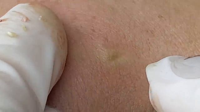 Черные точки, сидящие глубоко в порах - SDS#184