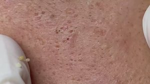 Asmr. Чистим кожу от белых точек. - ТТ#65