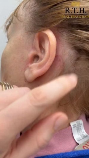 Три месяца после подтяжки лица -  этап, когда можно оценить эстетику рубцов!