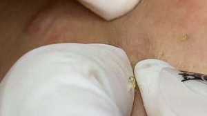 Чистка без слез: удаляем комедоны - SDS#185