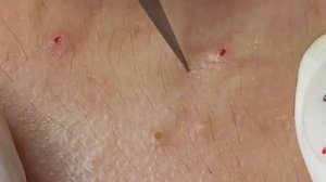 Выдавливание прыщей, угрей, черных точек и камедонов #246