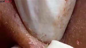 Asmr. Чистка кожи от больших угрей. #500392