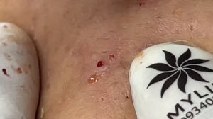 Asmr. Чистим кожу от угрей Linh #11