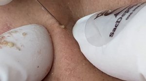 Asmr. Избавление от угрей и черных точек. - ТТ#67