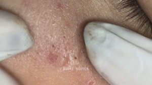 Чистка крупных комедонов и акне Suri 34