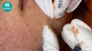 Asmr. Механическая чистка от угрей HANA #56