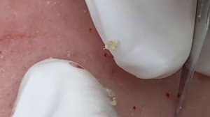 Прощай, акне! Эффективное лечени SDS#173