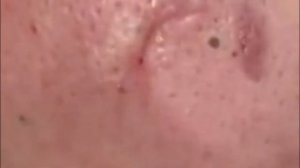 Чистка лица от угрей и акне. Выдавливание прыщей. Удаление черных точек и комедонов