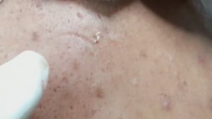 Эффективное лечение закрытых комедонов и подкожных прыщей Vân