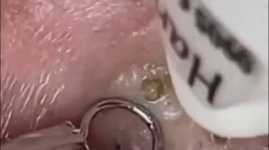 Чистка лица от угрей и акне. Выдавливание прыщей. Удаление черных точек и комедонов