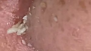 Чистка лица от угрей и акне. Выдавливание прыщей. Удаление черных точек и комедонов