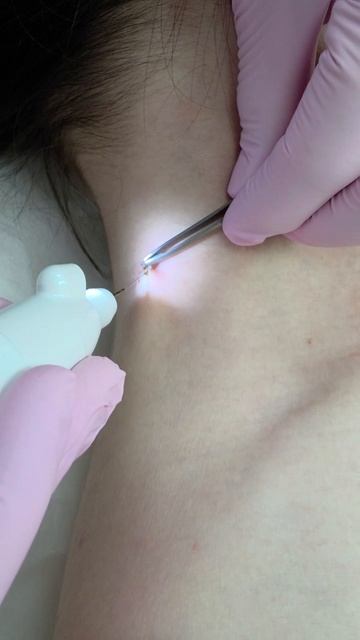 Удаление папиллом