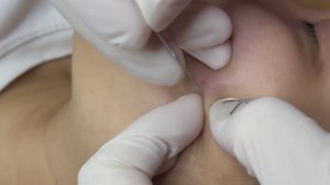 Чистим кожу от закрытых комедонов и черных точек - ТТ#64