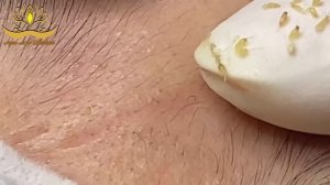 Asmr. Избавляемся от акне и белых точек. Anna #009