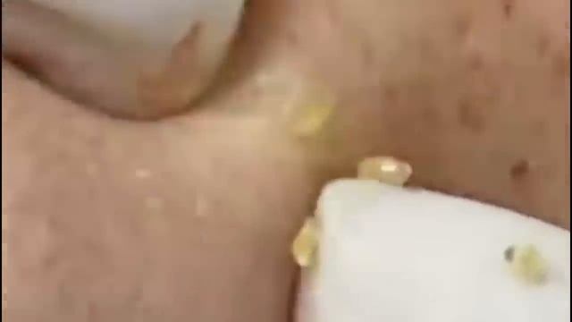 #30 Чистка лица от угрей и акне. Выдавливание прыщей. Удаление черных точек и комедонов