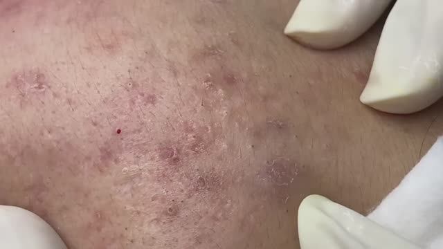 Asmr. Профессиональная чистка от белых точек. Win #136