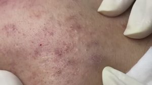 Asmr. Профессиональная чистка от белых точек. Win #136