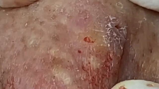 Чистка лица от милиумов: профессиональная процедура 𝐖𝐢𝐧 #𝟏𝟐𝟒𝟗