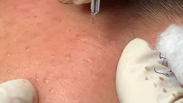 Закрытые комедоны и белые угри #049 Nang