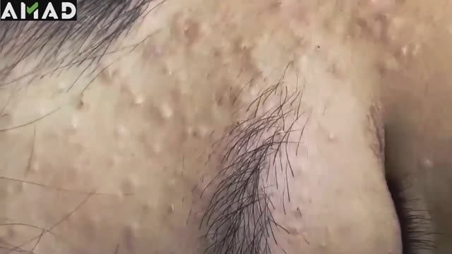 Asmr. Чистка кожи от больших угрей. #500392