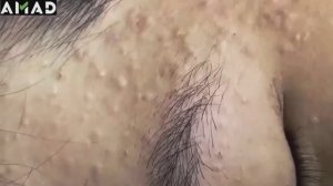 Asmr. Чистка кожи от больших угрей. #500392