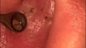 Чистка лица от угрей и акне. Выдавливание прыщей. Удаление черных точек и комедонов