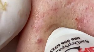 Выдавливание прыщей, угрей, черных точек и камедонов #252