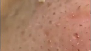 Чистка лица от угрей и акне. Выдавливание прыщей. Удаление черных точек и комедонов