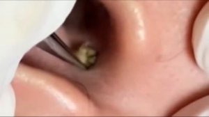 Чистка лица от угрей и акне. Выдавливание прыщей. Удаление черных точек и комедонов