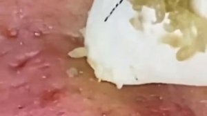 Чистка лица от угрей и акне. Выдавливание прыщей. Удаление черных точек и комедонов