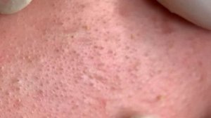 Удаление закрытых комедонов (подкожных прыщей) на лице #045 Hương